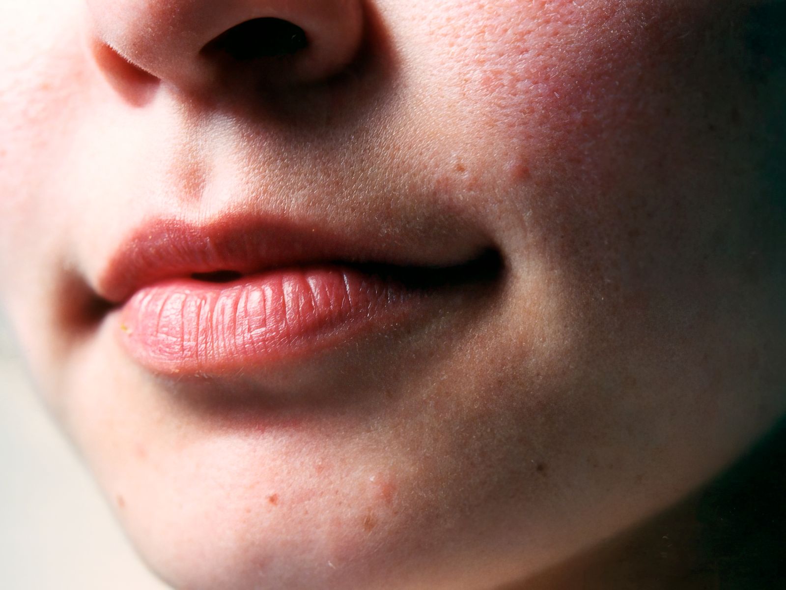 Lip flip behandeling in Hoofddorp - Doctor Den