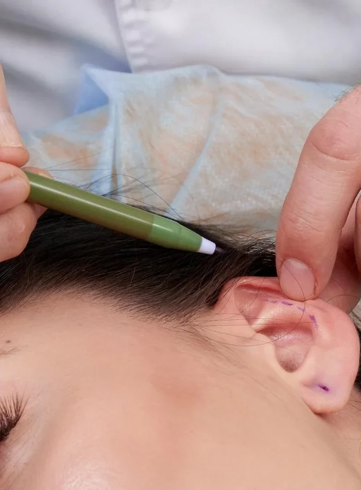 What is Ear Aesthetics (Otoplasty)
